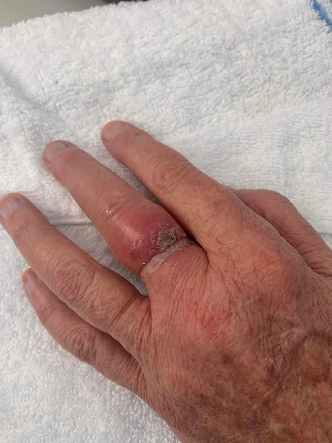 Read more about the article Elderly lady required emergency ring removal.