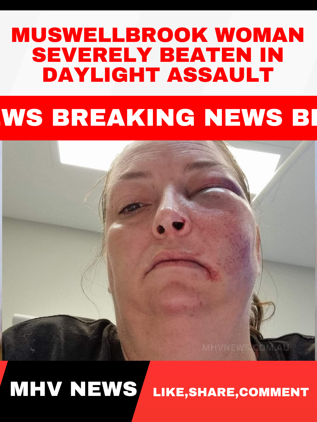 You are currently viewing Muswellbrook Woman Severely Beaten in Daylight Assault